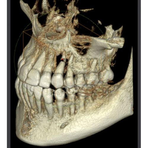 RAYSCAN Symphony a-OCL – ортопантомограф c цефалостатом (One Shot), 33х33 см