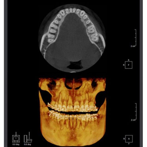 RAYSCAN Symphony a-OCL – ортопантомограф c цефалостатом (One Shot), 33х33 см